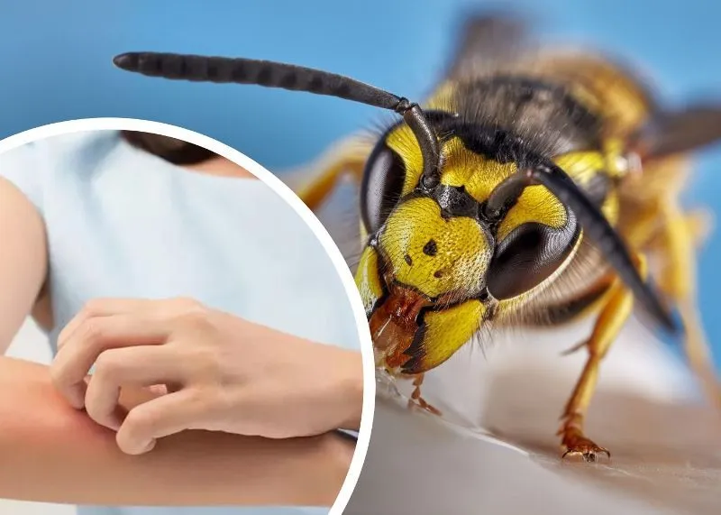Что делать, если укусила оса или пчела - советы